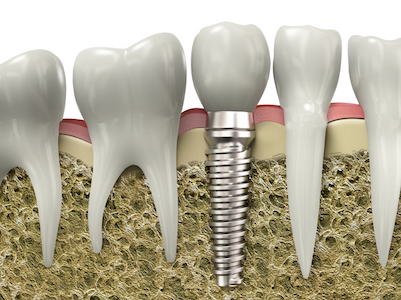 Image of a dental implant which is a typical restorative dentistry service to replace a tooth. 