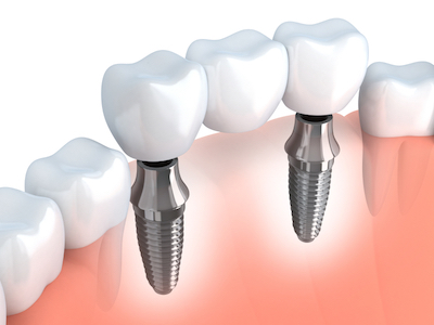 3D image of how a dental implants bridge fits between natural teeth.